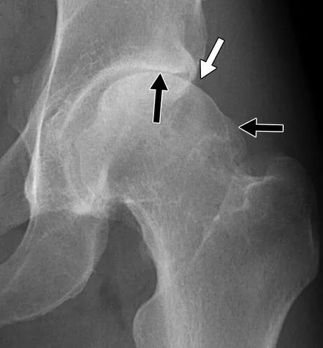 中老年不能忽视的髋关节骨性关节炎!