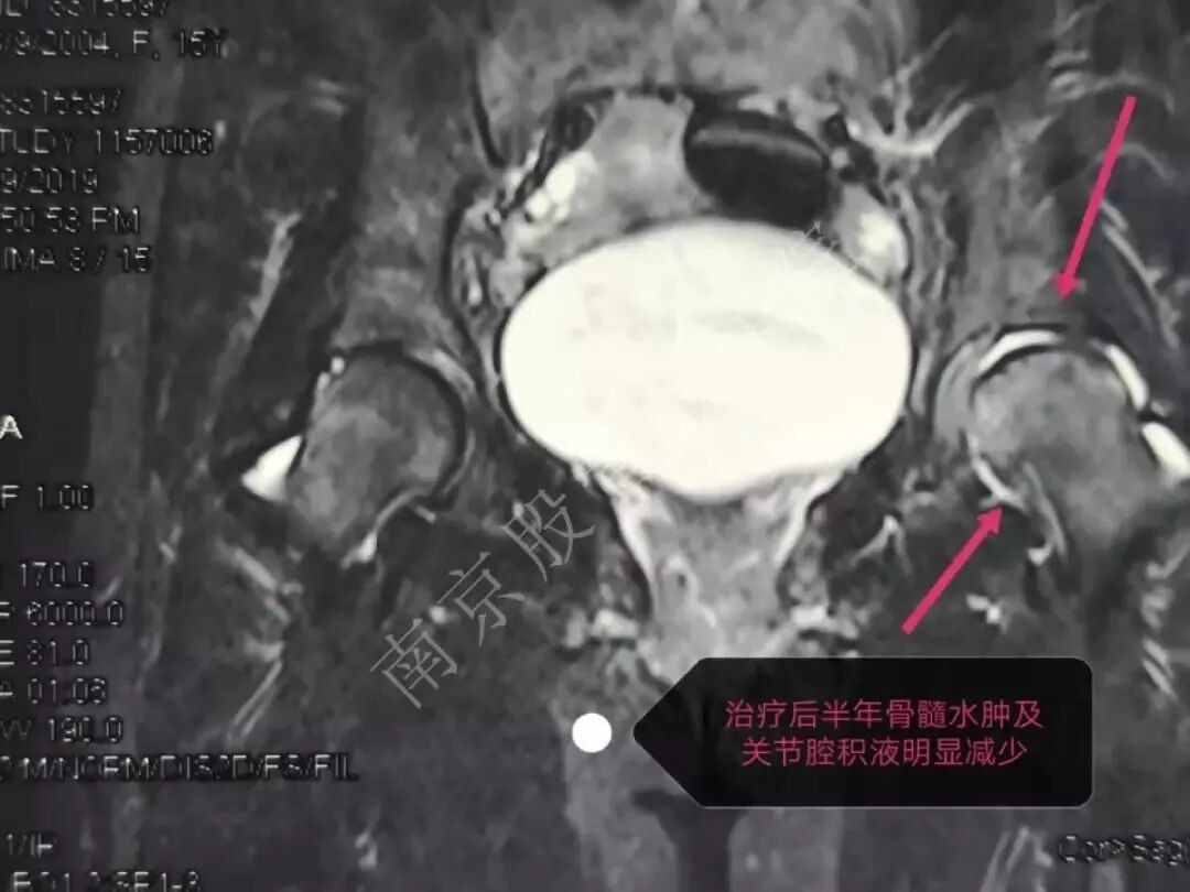 "阀门"无法关闭,后续的问题仍会层出不穷,骨小梁微骨折,滑膜软骨受损