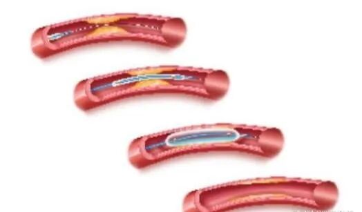pta在医学上什么意思科室协作新典范  打通患者“生命线”——我院肾内科成功开展首例DSA引导下动静脉内瘘球囊扩张术_https://www.jmylbn.com_新闻资讯_第8张