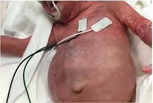 皮肤粘合剂怎么去掉早产儿医用粘合剂相关皮肤损伤和化学损伤案例_https://www.jmylbn.com_新闻资讯_第6张