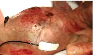 皮肤粘合剂怎么去掉早产儿医用粘合剂相关皮肤损伤和化学损伤案例_https://www.jmylbn.com_新闻资讯_第5张