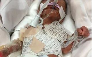 皮肤粘合剂怎么去掉早产儿医用粘合剂相关皮肤损伤和化学损伤案例_https://www.jmylbn.com_新闻资讯_第4张