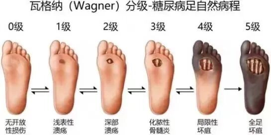 为什么糖尿病不能震动【广大糖友的福音！】糖尿病周围神经病变筛查之震动感觉阈值检测_https://www.jmylbn.com_新闻资讯_第7张