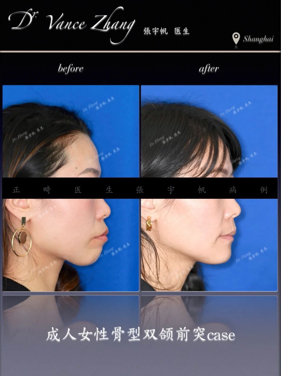 成人女性骨型双颌前突矫正正式病例贴图1