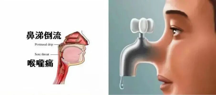 【鼻炎】“鼻涕倒流”不一定是鼻涕分泌太多，很可能是因为这些！
