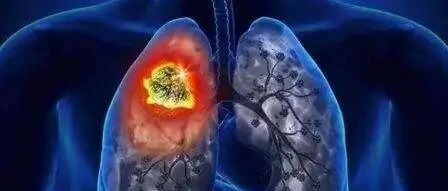 两年前58岁赵女士因腹痛入院，一查竟是肝癌，她是如何患者“自救”成功的