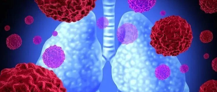 肺癌术后胸腔积液，化疗副反应重，中医健脾扶正，内外合治，症状明显改善