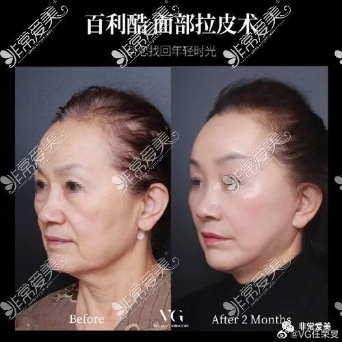 韩国做拉皮手术不知道这几家医院很吃亏 非常爱美 微信公众号文章阅读 Wemp