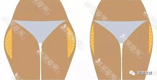 全身抽脂有什么危害吗_全身抽脂副作用_全身抽脂风险