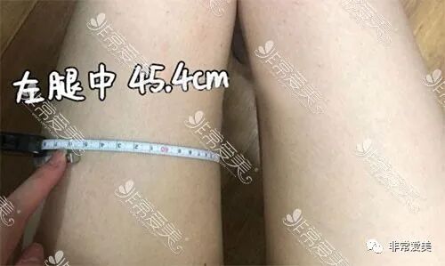 全身抽脂有什么危害吗_全身抽脂副作用_全身抽脂风险