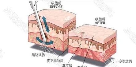 全身抽脂副作用_全身抽脂有什么危害吗_全身抽脂风险