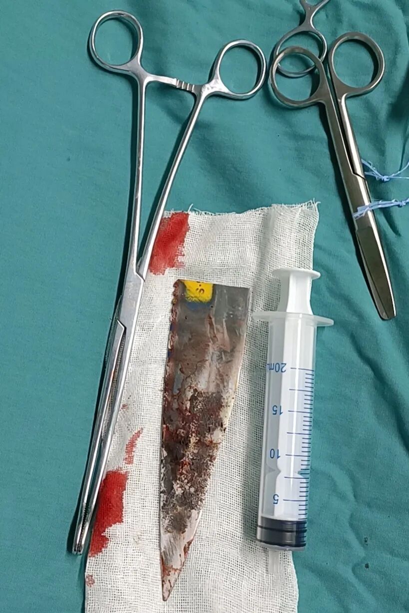 气管插管怎么取出惊险！20厘米尖刀刺入鼻面部，多科医生协作成功取出_https://www.jmylbn.com_新闻资讯_第7张