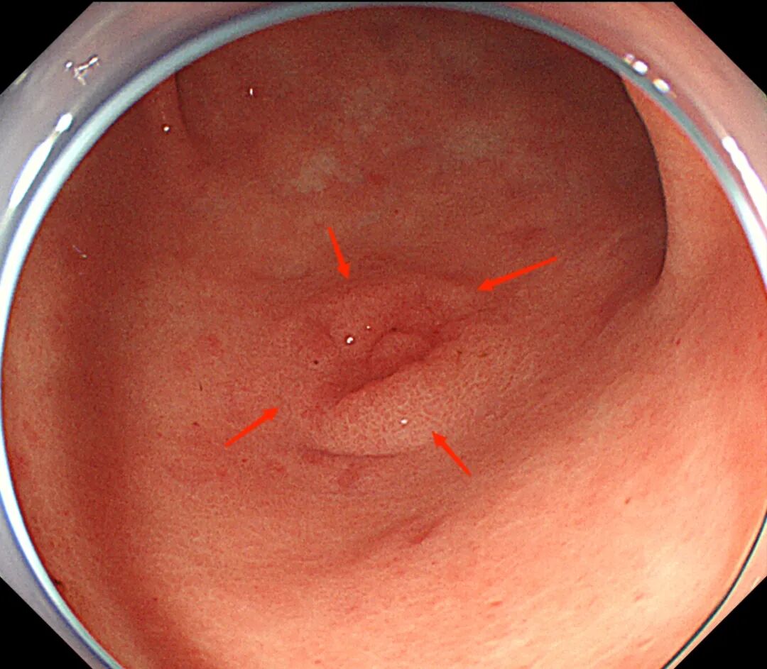 什么是电子胃镜【科普】精查胃镜到底是什么？什么人需要精查胃镜？_https://www.jmylbn.com_新闻资讯_第4张