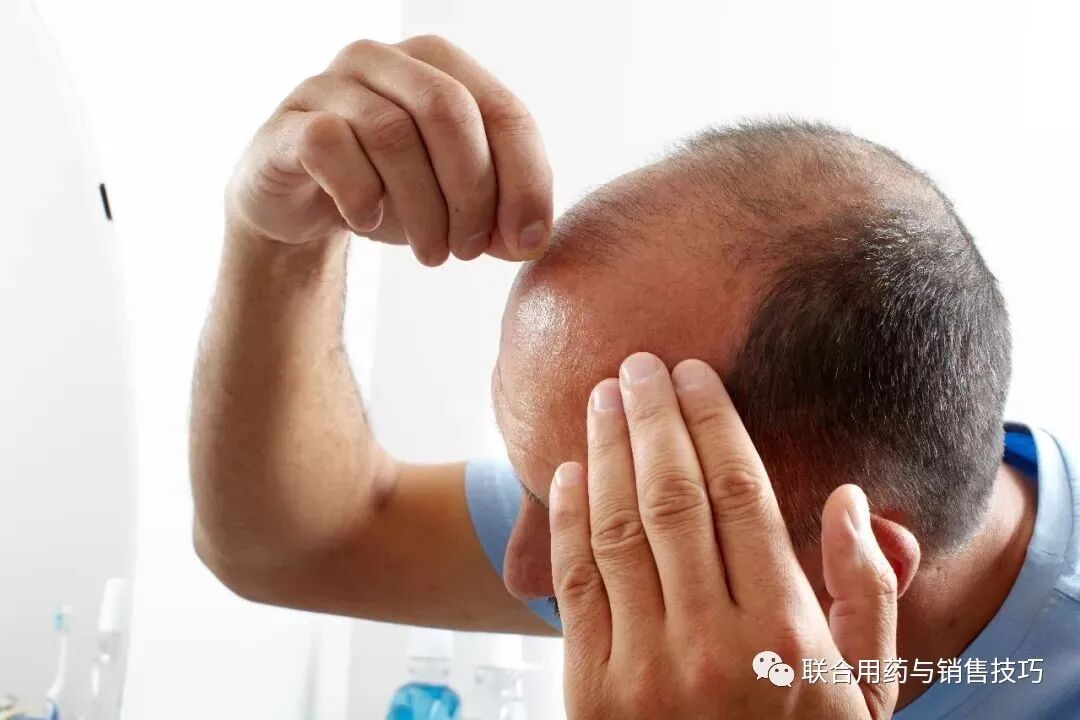 脂溢性脱发的联合用药方案