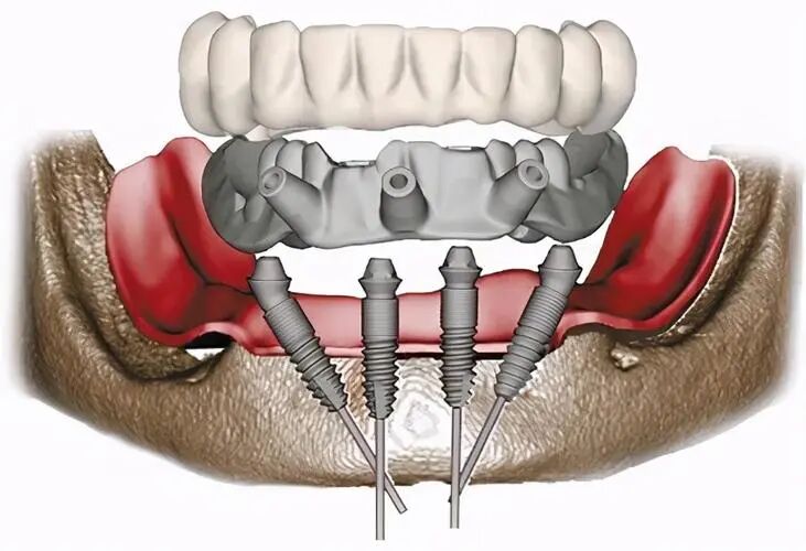 数字牙片机怎么用【推广】数字化技术让口腔种植更精准_https://www.jmylbn.com_新闻资讯_第1张