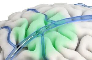 An illustration showing a neurological device, the Synchron Stentrode brain implant sensing motor signals.