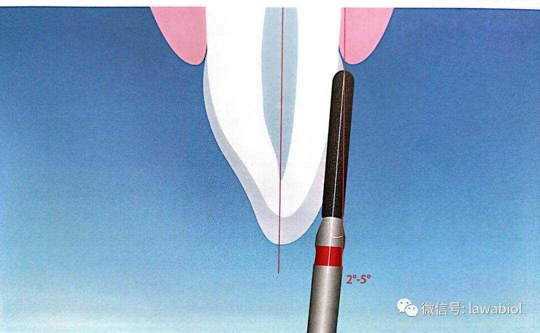 一起来读书丨《牙体预备标准化操作》第五节:前牙固位型全冠牙体预备