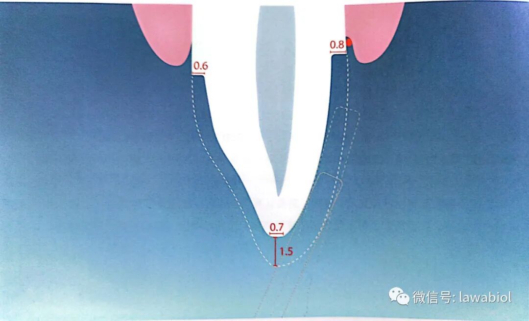 一起来读书丨《牙体预备标准化操作》第五节:前牙固位型全冠牙体预备