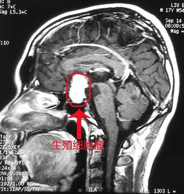 神外科普 l 生殖细胞瘤