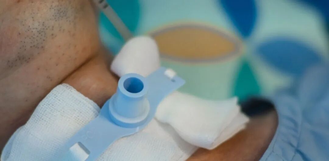 呼吸机湿化罐怎么加水谢克亮教授：ICU机械通气中的湿化与感控_https://www.jmylbn.com_新闻资讯_第5张