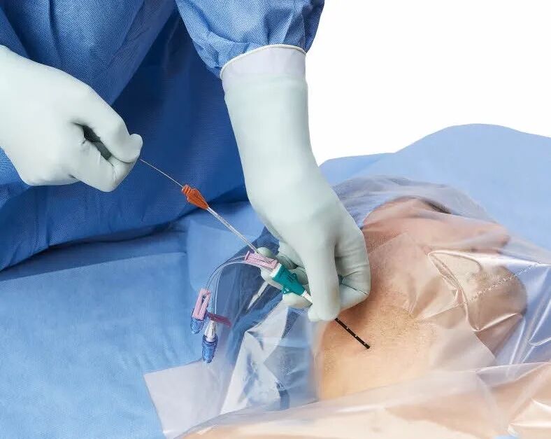 双腔cvc怎么开关中心静脉导管的另类知识，你了解多少？_https://www.jmylbn.com_新闻资讯_第2张