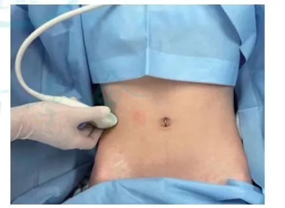 为什么用注射双泵腹横肌平面神经阻滞，让剖宫产术后不痛——“梦”已成真_https://www.jmylbn.com_新闻资讯_第9张