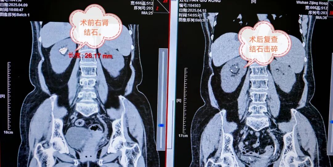 输尿管鞘是什么结石患者新福音——我院泌尿外科开展输尿管软镜联合可弯曲负压鞘碎石术_https://www.jmylbn.com_新闻资讯_第4张