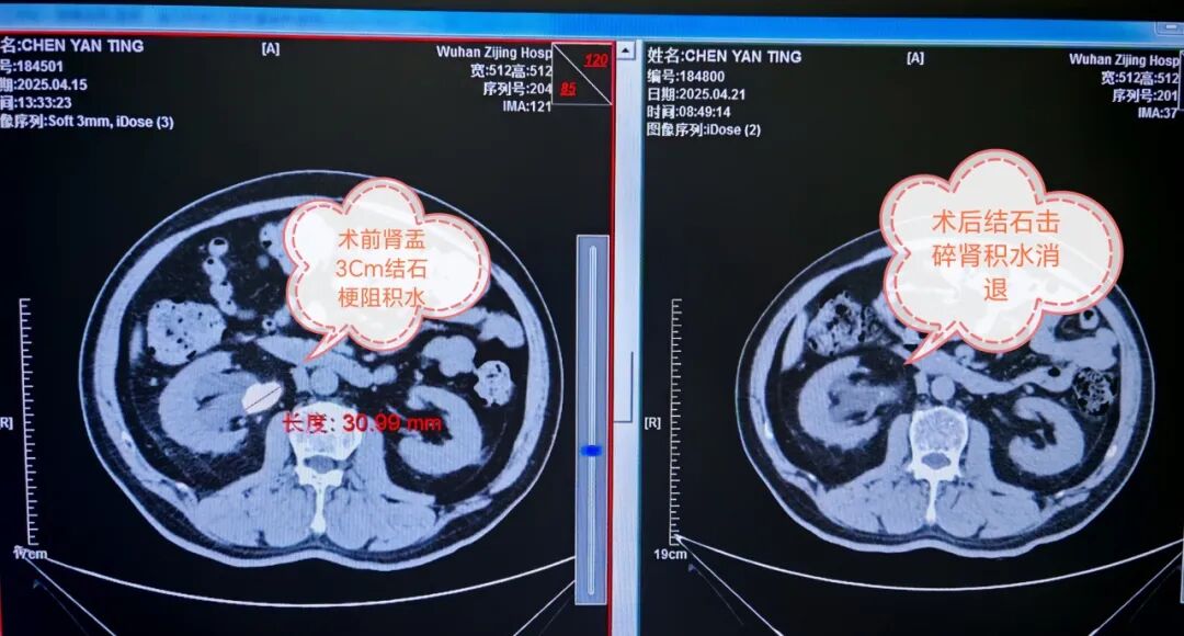 输尿管鞘是什么结石患者新福音——我院泌尿外科开展输尿管软镜联合可弯曲负压鞘碎石术_https://www.jmylbn.com_新闻资讯_第5张
