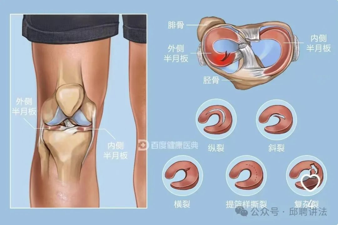 膝盖疼痛算不算工伤事故
