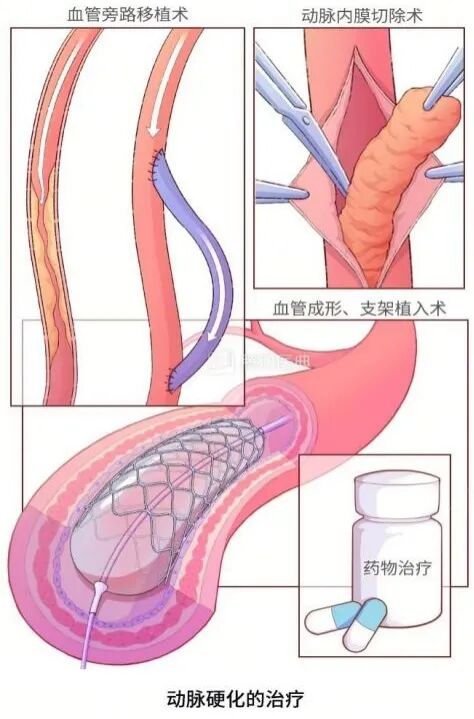 动脉硬化怎么检测动脉硬化检测仪——血管硬化的“照妖镜”_https://www.jmylbn.com_新闻资讯_第2张