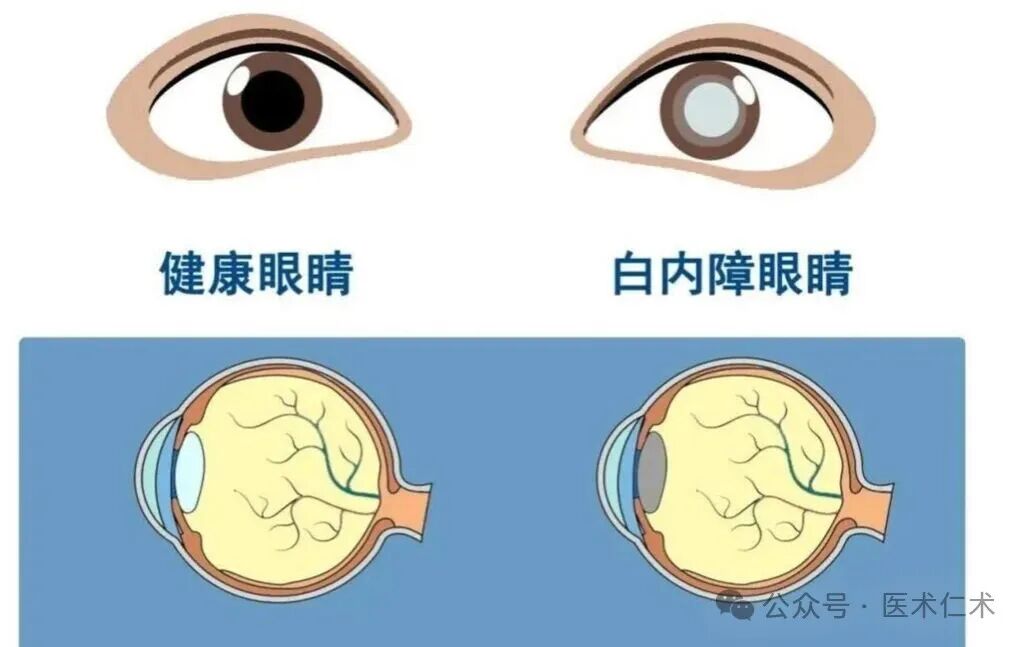 老年性白内障的常用中成药（口服及外用）