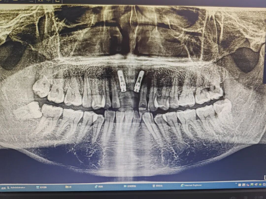 数字牙片机怎么用精准种植新突破！我院成功开展上前牙数字化种植导板手术_https://www.jmylbn.com_新闻资讯_第7张