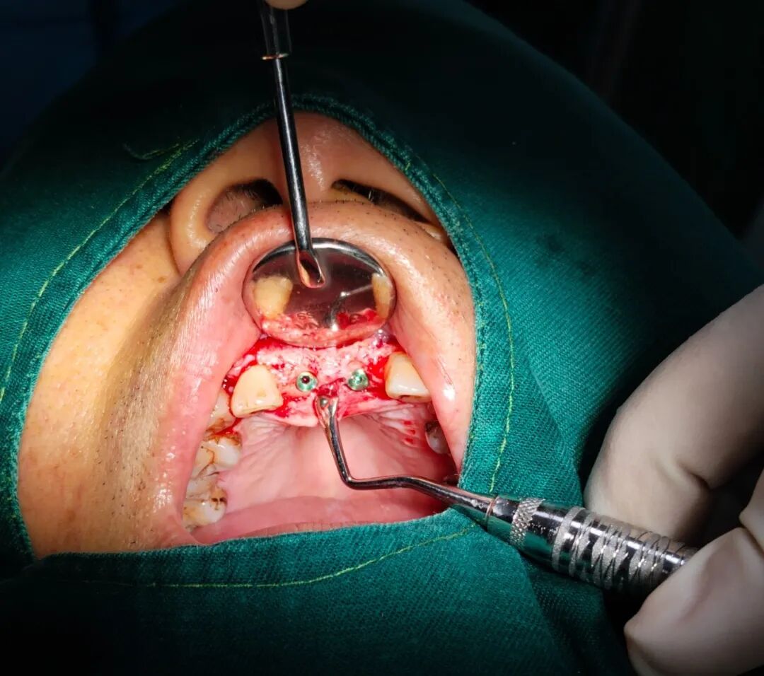 数字牙片机怎么用精准种植新突破！我院成功开展上前牙数字化种植导板手术_https://www.jmylbn.com_新闻资讯_第10张