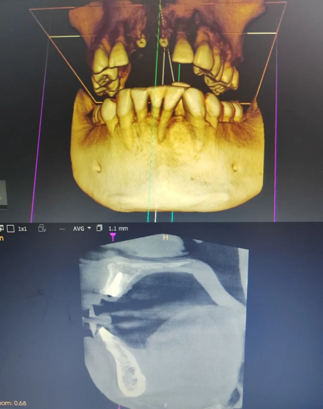 数字牙片机怎么用精准种植新突破！我院成功开展上前牙数字化种植导板手术_https://www.jmylbn.com_新闻资讯_第9张