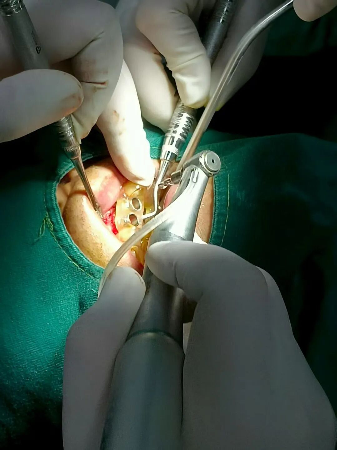 数字牙片机怎么用精准种植新突破！我院成功开展上前牙数字化种植导板手术_https://www.jmylbn.com_新闻资讯_第12张