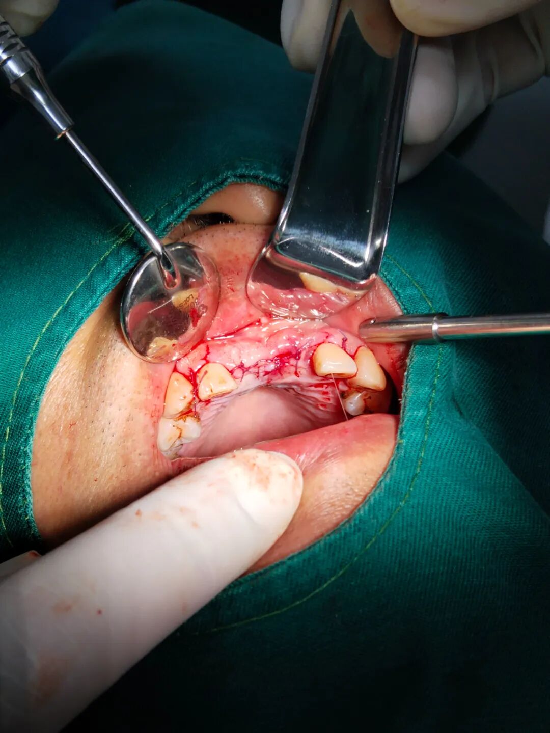 数字牙片机怎么用精准种植新突破！我院成功开展上前牙数字化种植导板手术_https://www.jmylbn.com_新闻资讯_第11张