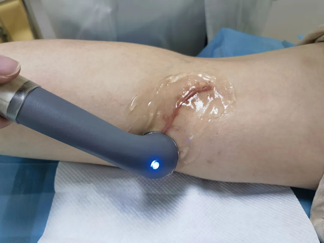 超声波治疗是什么什么是超声波治疗，有什么作用？_https://www.jmylbn.com_新闻资讯_第6张