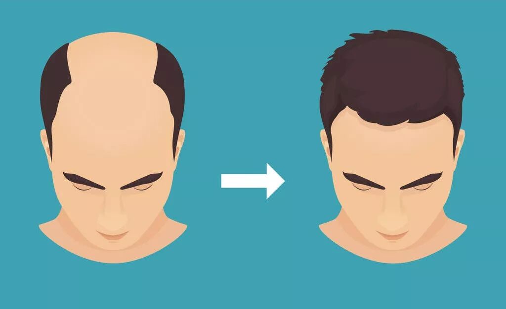 你为什么会秃顶？两项重磅研究为治疗脱发带来新希望