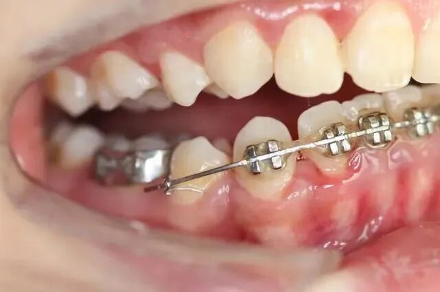 正畸颊面管是什么牙齿矫正，一根弓丝是怎么“工作”的？_https://www.jmylbn.com_新闻资讯_第3张