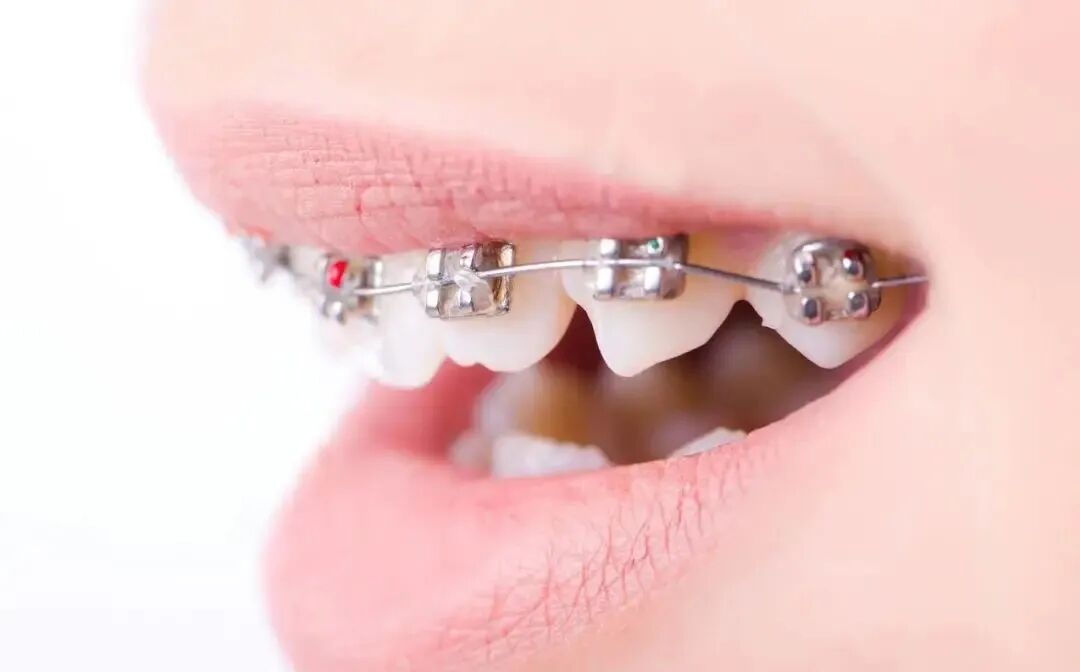 正畸颊面管是什么牙齿矫正，一根弓丝是怎么“工作”的？_https://www.jmylbn.com_新闻资讯_第7张