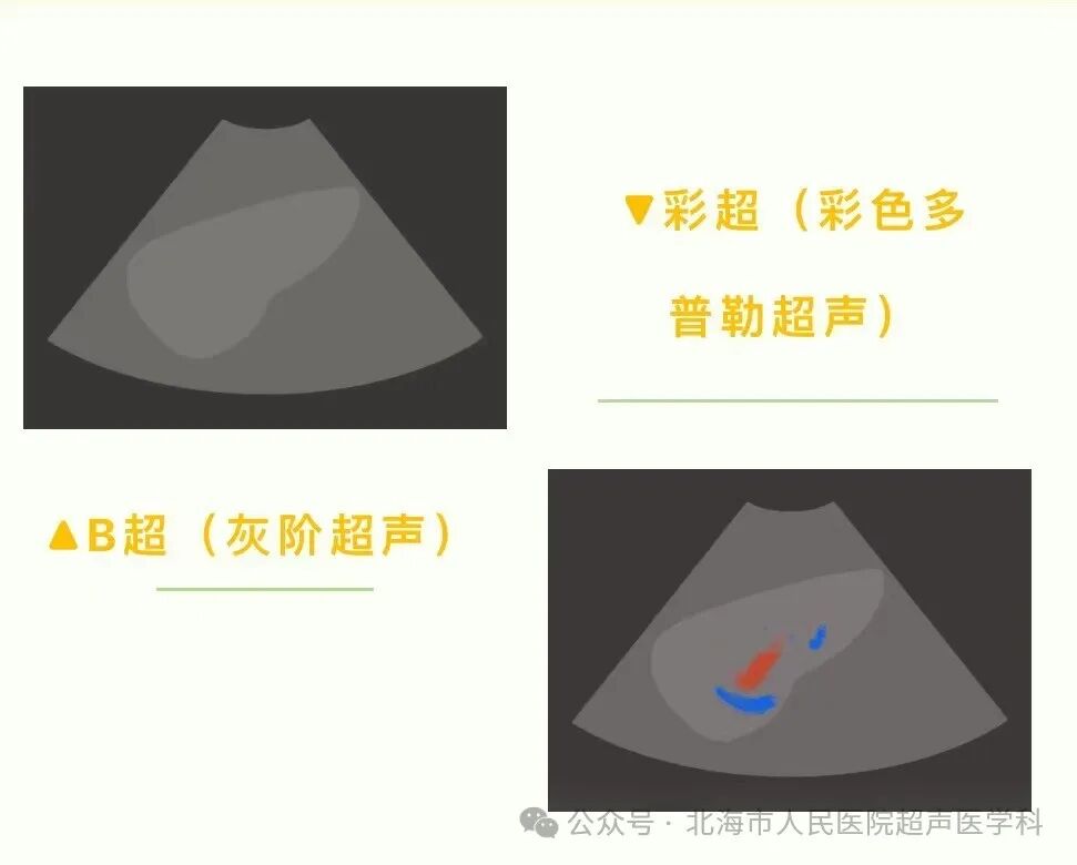 超声中什么黑什么白【超声科普】我做的彩超为什么是黑白的？超声可以鉴别男女吗？_https://www.jmylbn.com_新闻资讯_第3张
