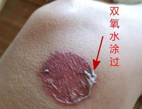 单质银为什么能抗菌“小伤口”也能致死？伤口消毒用什么，看这一篇就够了！_https://www.jmylbn.com_新闻资讯_第8张