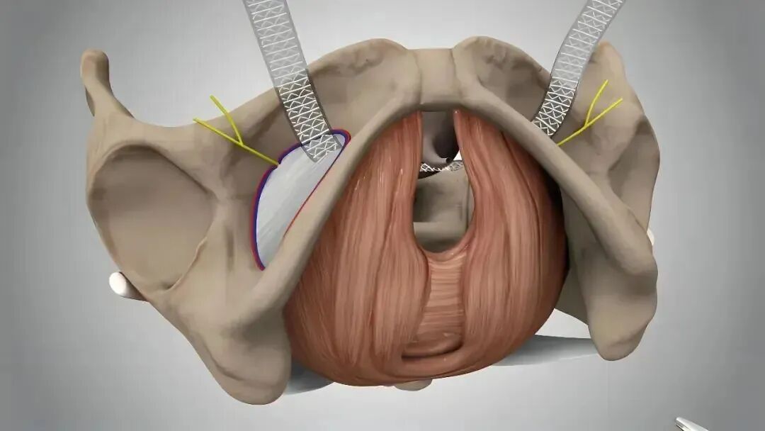 尿道张力过强怎么办【全州首例】黔西南州人民医院成功开展尿失禁“经闭孔无张力尿道悬吊术”_https://www.jmylbn.com_新闻资讯_第2张