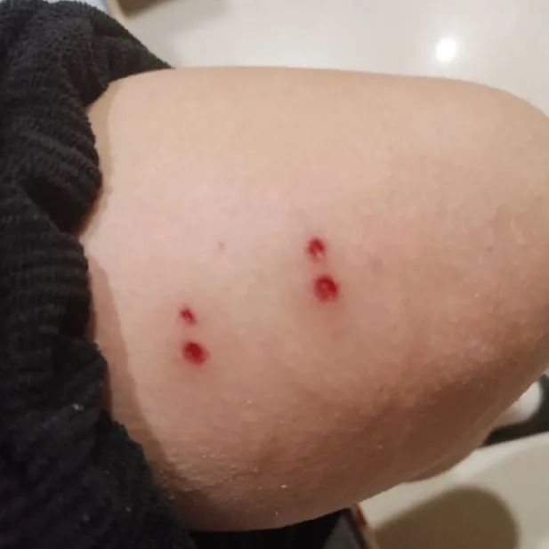 蟑螂咬人的伤口图片图片