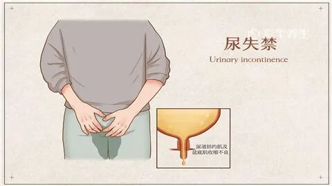 马尾神经损伤病人神经源性膀胱症状