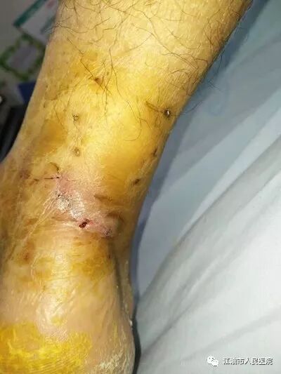 小切口解决大麻烦我院骨科开展关节镜辅助跟腱断裂微创手术治疗