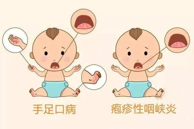 不同:疱疹性咽峡炎只有口腔和软腭会长疱疹,咽痛明显;手足口病在口