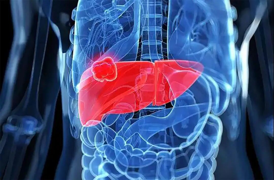 FISH怎么诊断CTC【SE-i·FISH-CTC超早期肿瘤筛查】年年体检却查出晚期癌症！90%的人防癌筛查都做错了​！_https://www.jmylbn.com_新闻资讯_第15张