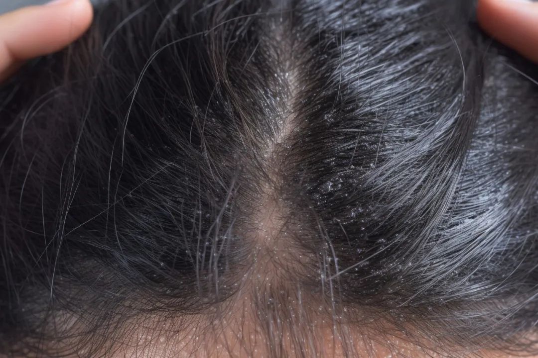 头皮屑多，只是因为清洁不到位？也可能是这些原因……