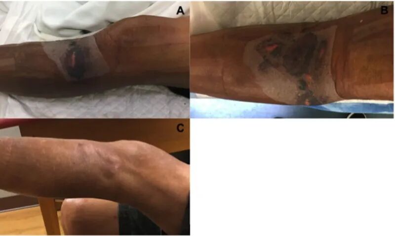 骨科伤口，干性愈合好还是湿性愈合好？：湿性愈合